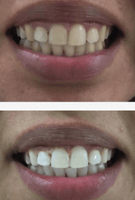 Load image into Gallery viewer, SNOW TEETH WHITENING™ – SYSTEM DO WYBIELANIA ZĘBÓW W DOMU [ZESTAW WSZYSTKO W JEDNYM]
