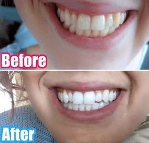 SNOW TEETH WHITENING™ SYSTÈME À DOMICILE [KIT TOUT-EN-UN]