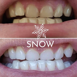 SISTEMA EM CASA SNOW TEETH WHITENING™ [‘KIT’ COMPLETO]