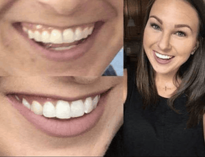 Snow® Teeth Whitening At-Home System [For SweatCoin]