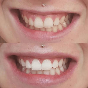 SISTEMA EM CASA SNOW TEETH WHITENING™ [‘KIT’ COMPLETO]