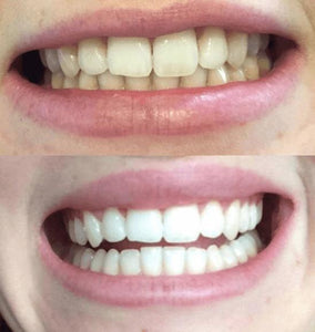 SNOW TEETH WHITENING™ – SYSTEM DO WYBIELANIA ZĘBÓW W DOMU [ZESTAW WSZYSTKO W JEDNYM]