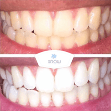 Load image into Gallery viewer, SISTEMA EM CASA SNOW TEETH WHITENING™ [‘KIT’ COMPLETO]
