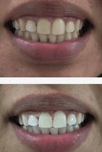 SNOW TEETH WHITENING™ ZAHNWEISS-SYSTEM FÜR ZUHAUSE [ALL-IN-ONE KIT]