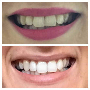 Snow® Teeth Whitening At-Home System [For SweatCoin]